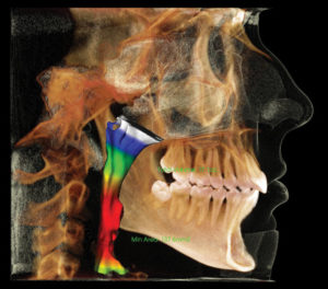 Photo of an airway